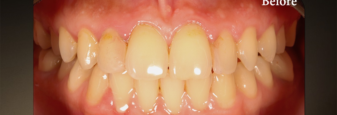 Orthodontic Arch Alignment Before & After