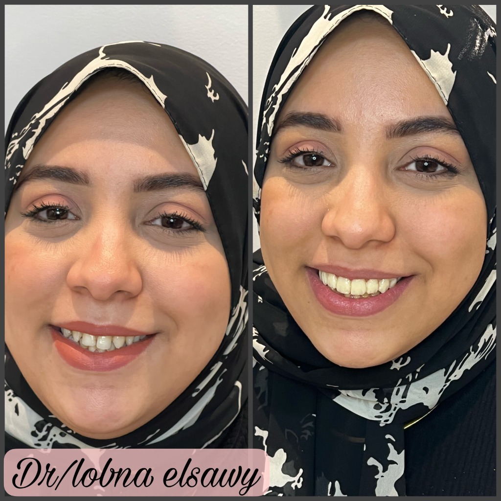 Harmonious Smile Alignment & Aesthetic Contouring