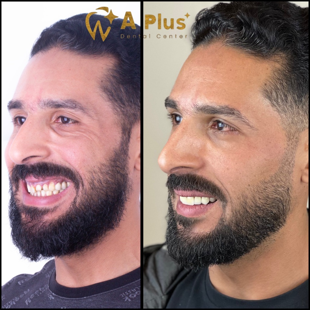 Comprehensive Aesthetic Rehabilitation & Veneers