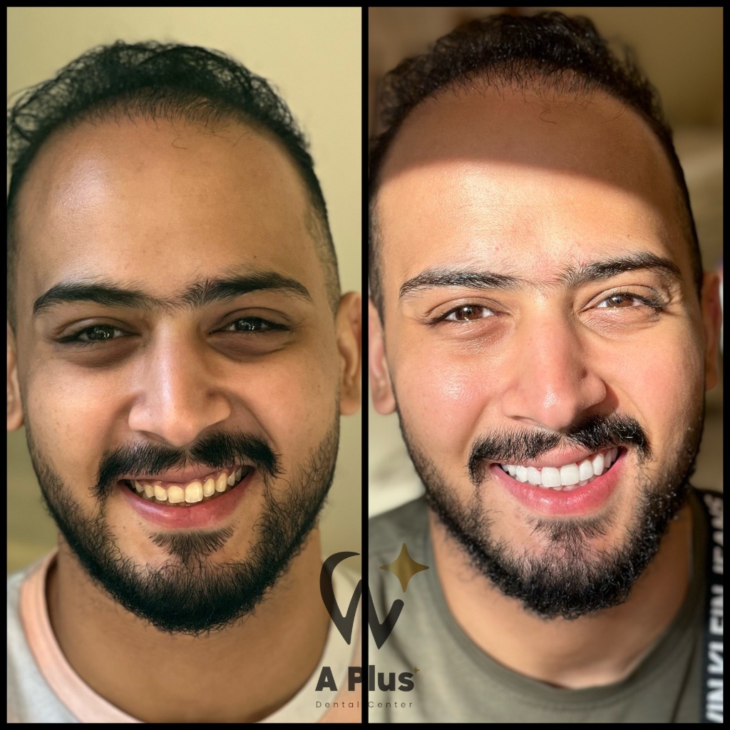 High-Precision Ceramic Veneer Transformation