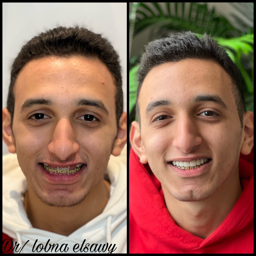 Anterior Arch Alignment & Bite Correction