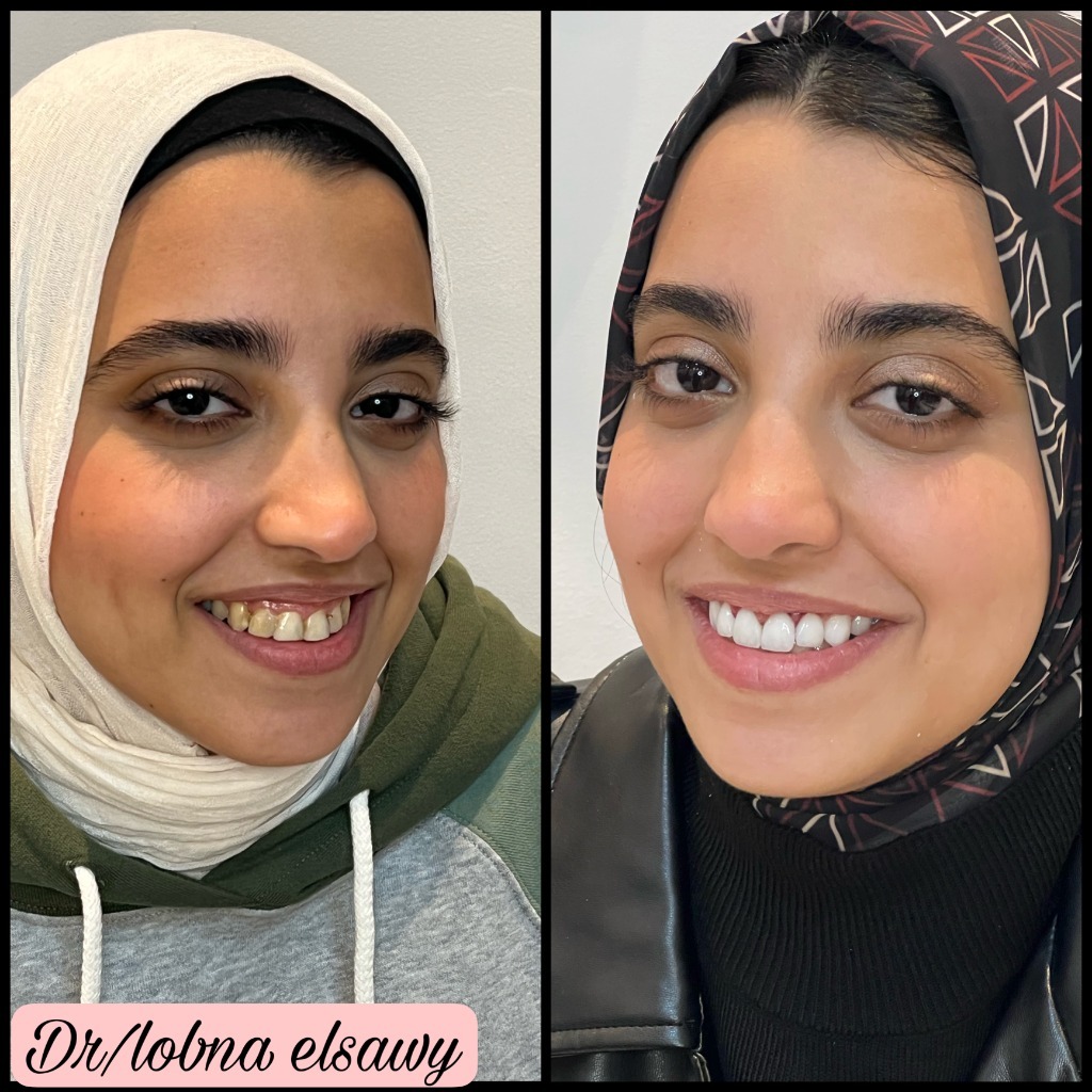 Gingival Harmony & Conservative Ceramic Transformation