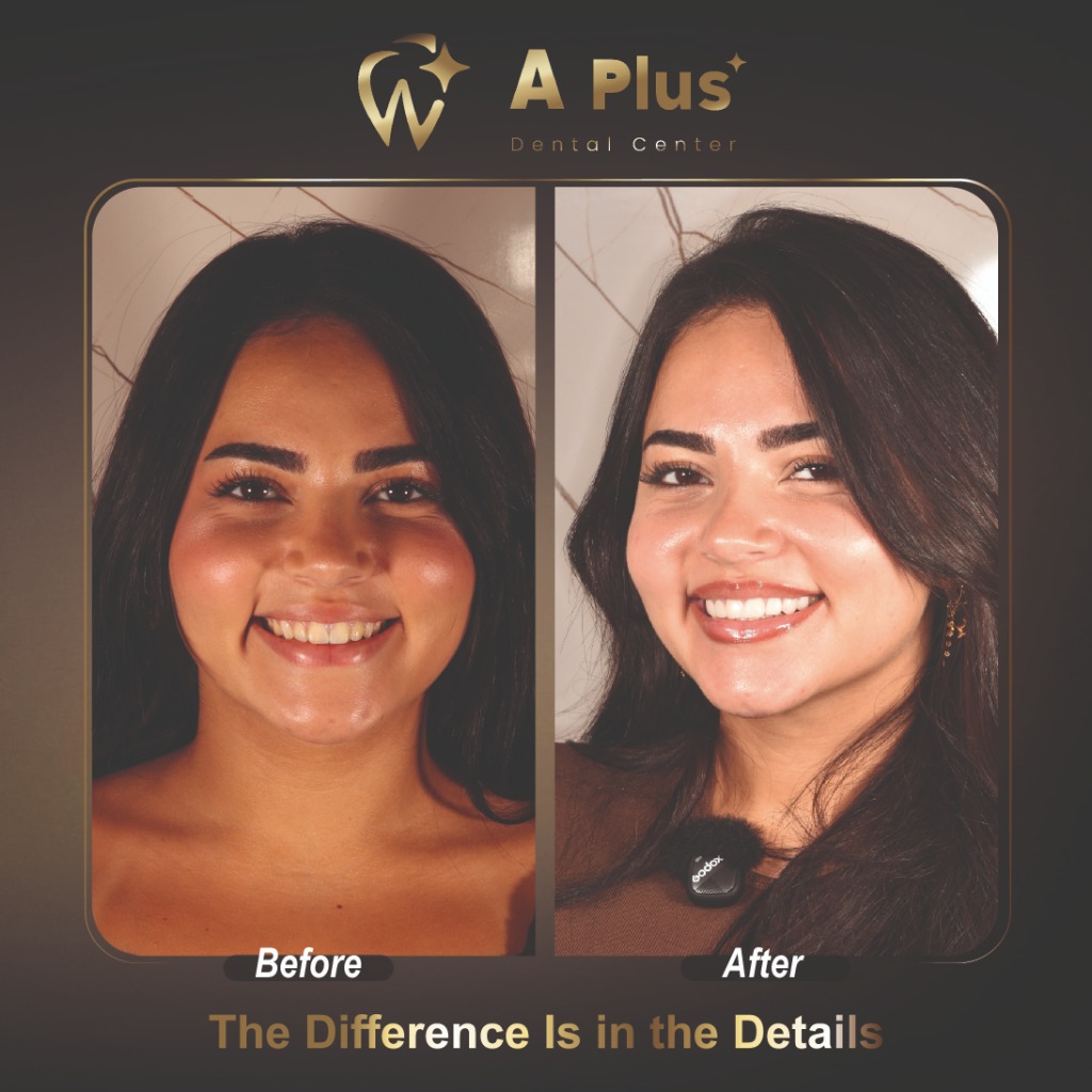 The Difference Is in the Details: Complete Smile Transformation
