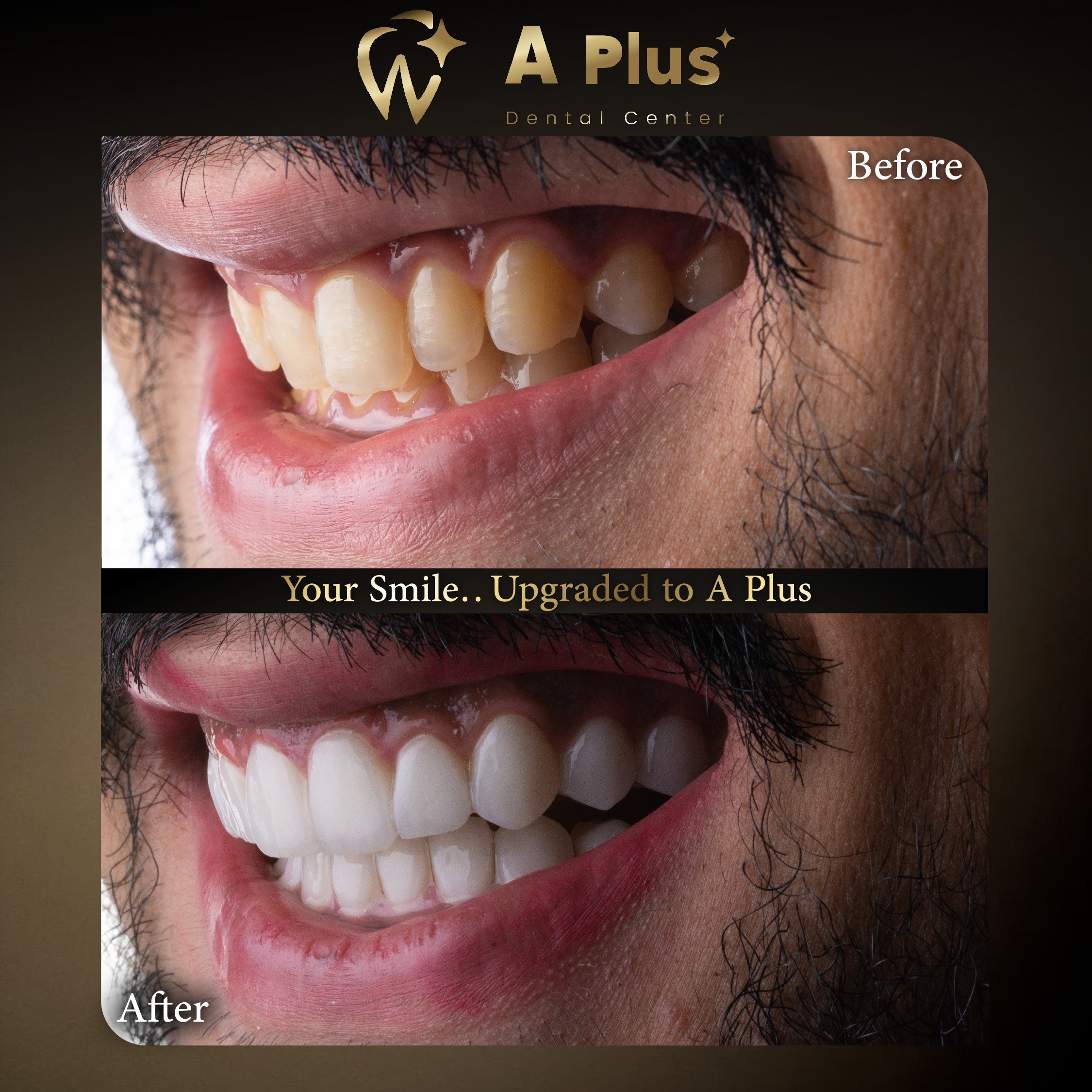 ترقية ابتسامتك مع A Plus: تصميم وتجميل شامل للابتسامة