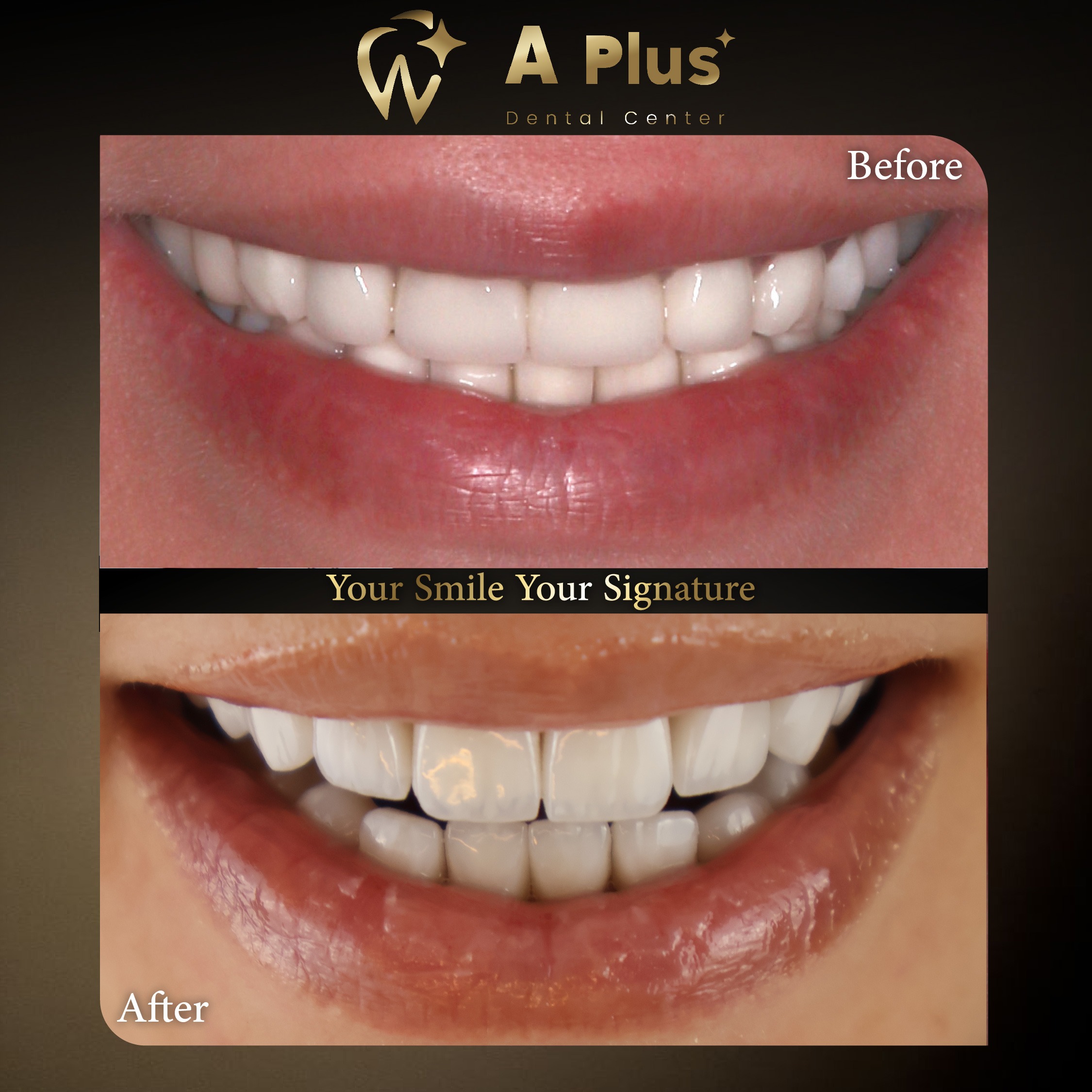 ابتسامتك بصمتك الخاصة: تصميم الابتسامة عالي الدقة