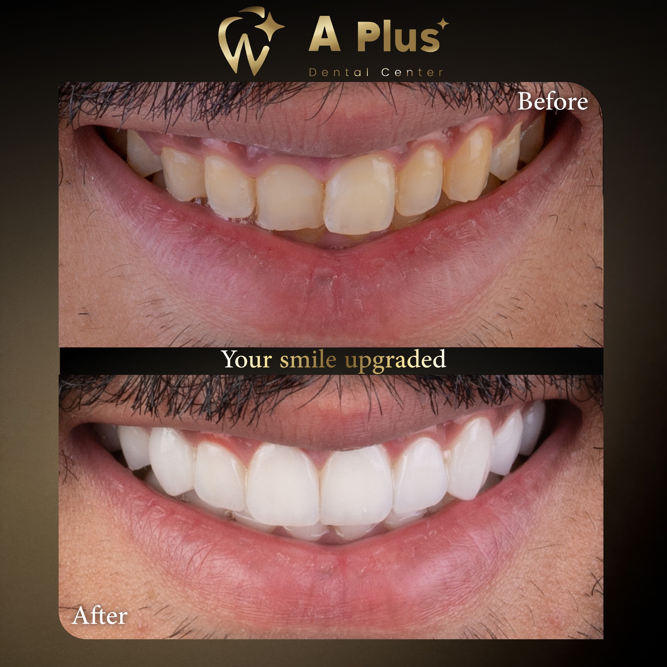 ترقية شاملة للابتسامة: تنسيق وتجميل الأسنان المتقدم
