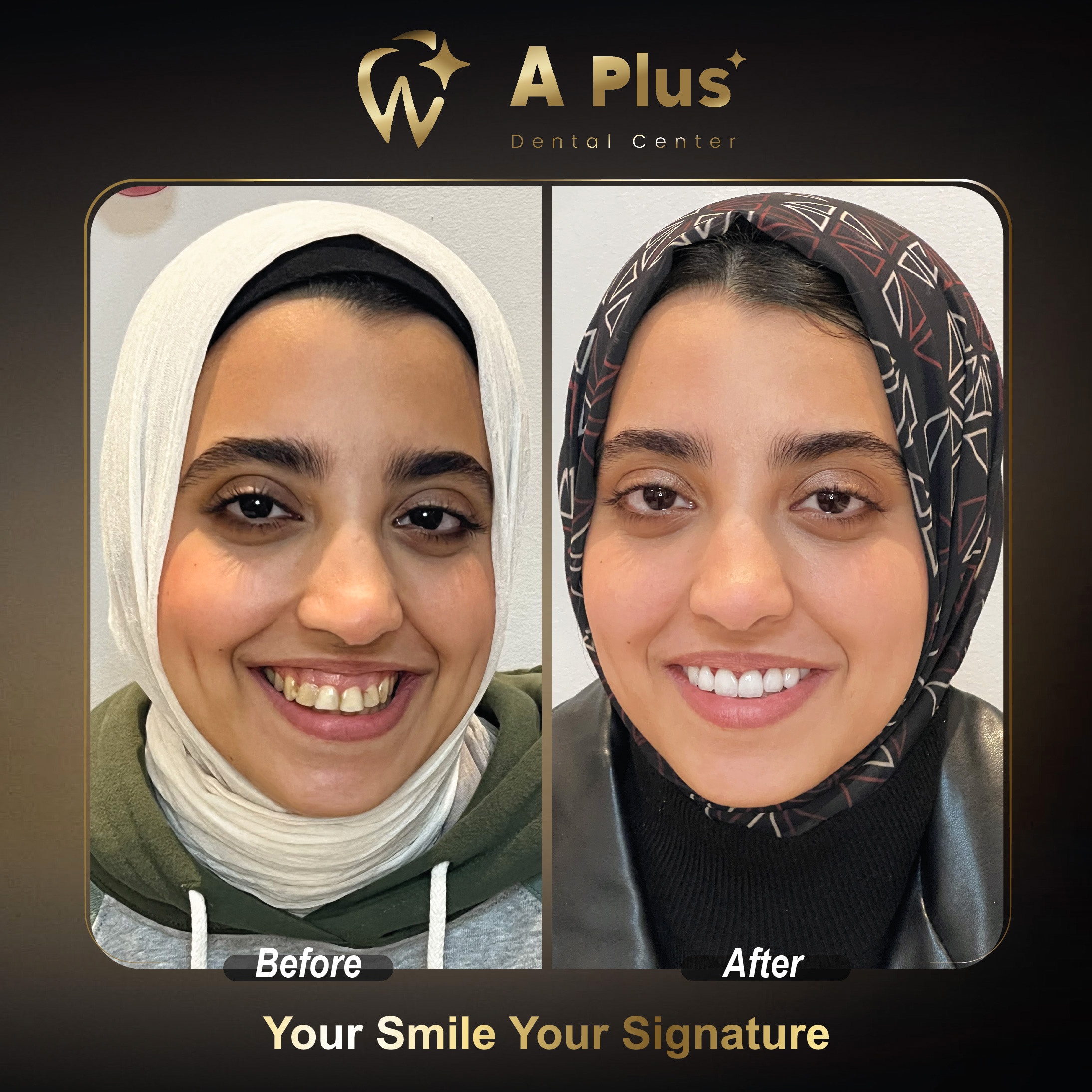 ابتسامتك بصمتك الخاصة: تجميل الأسنان بعدسات الفينير