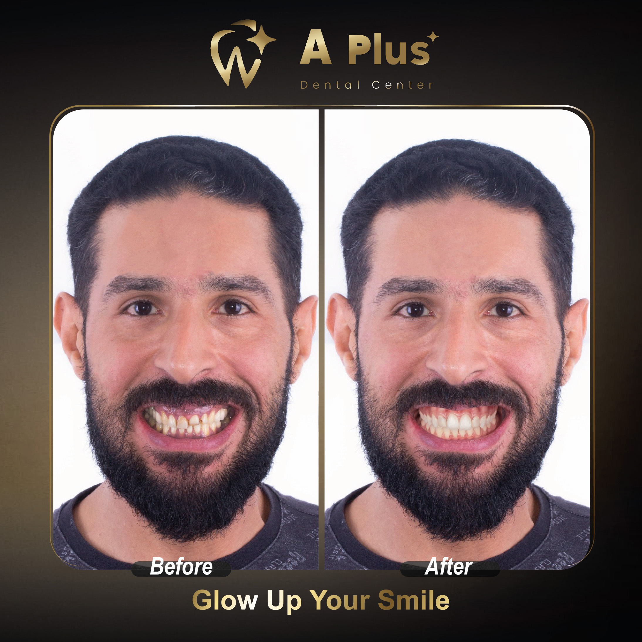 تنسيق وتجميل شامل للابتسامة ومحاذاة الأسنان