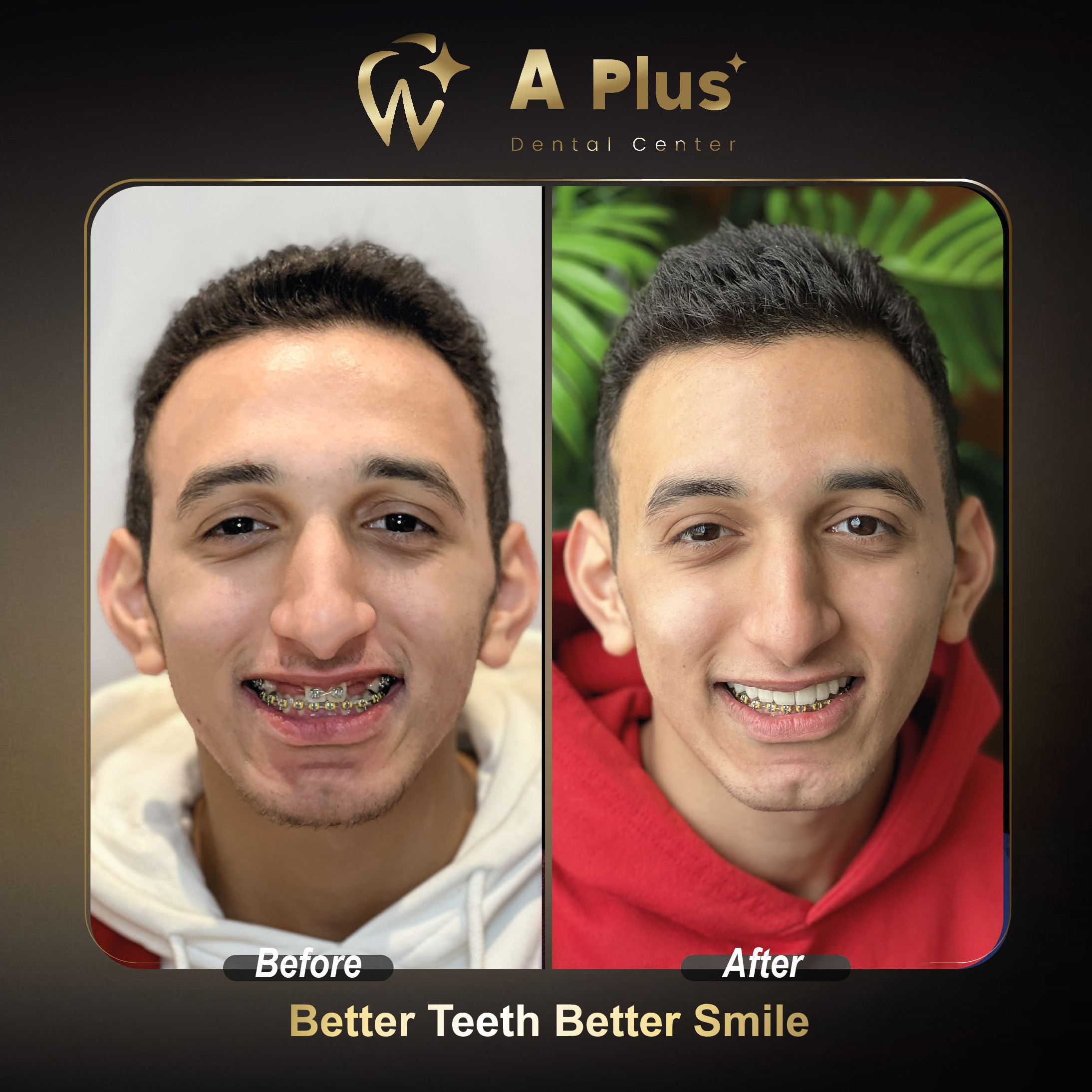 توسيع وتنسيق القوس السني والتقويم التجميلي
