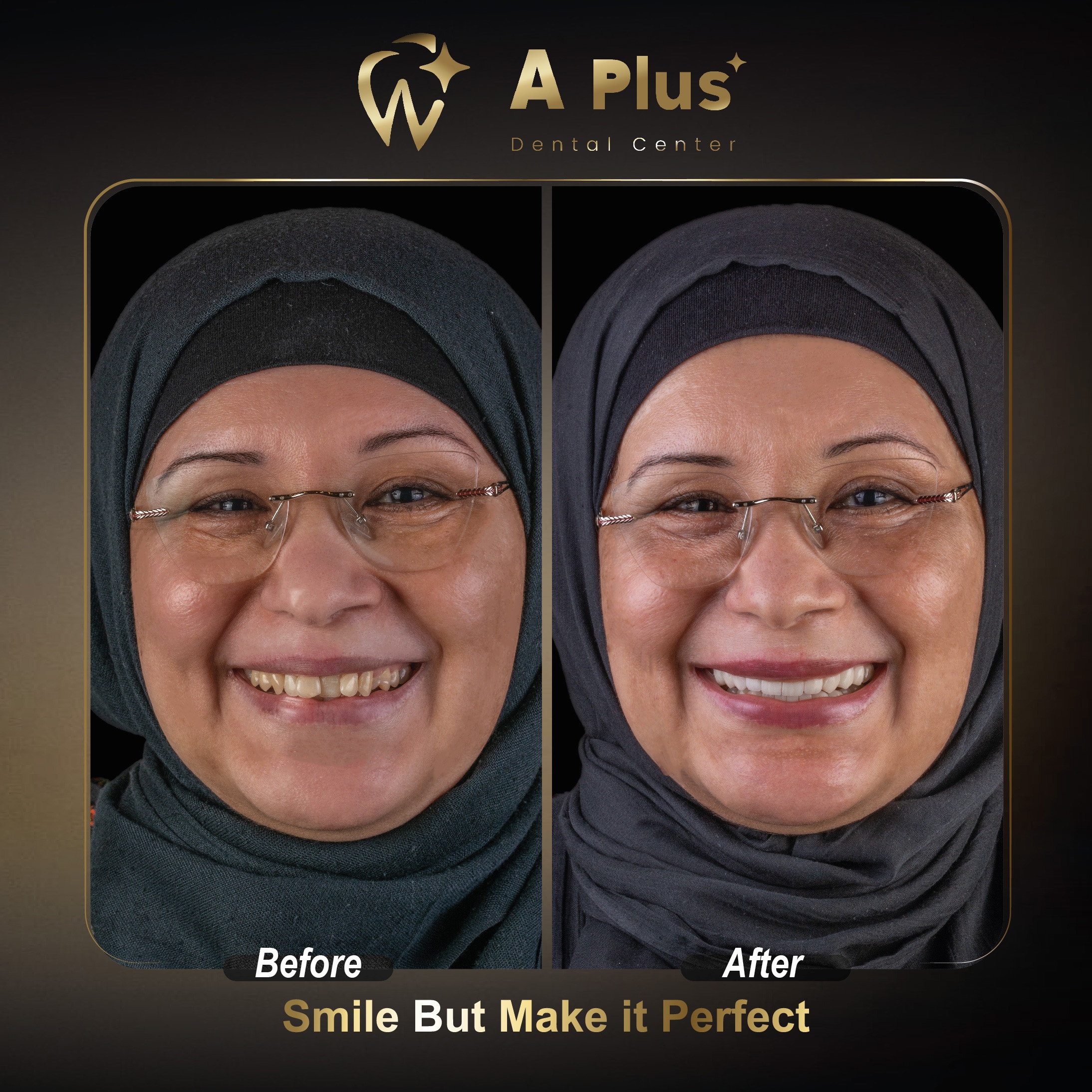 تركيبات تيجان إيماكس الخزفية عالية الدقة والشفافية