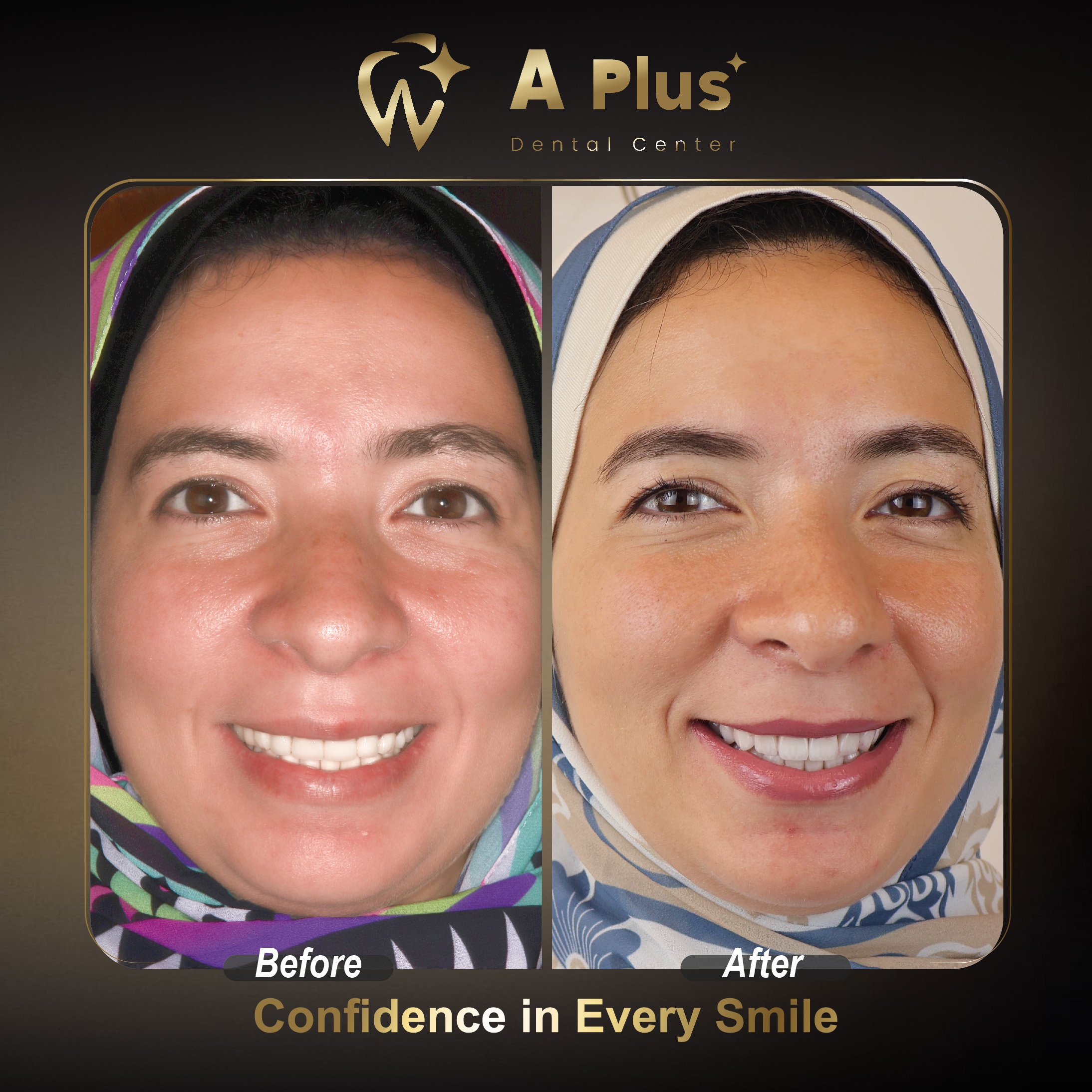 تجميل وتنسيق الابتسامة بتركيبات إيماكس الطبيعية